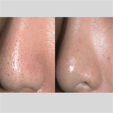 Large Pores On Nose