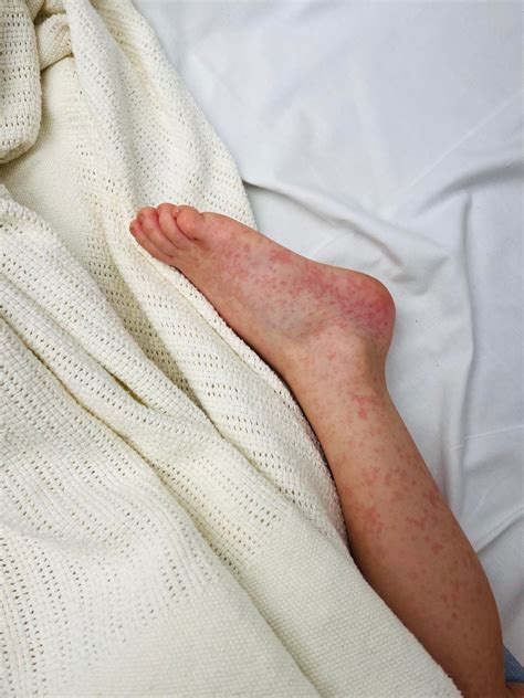 Strep Infection Rash On Legs at Humberto Watts blog