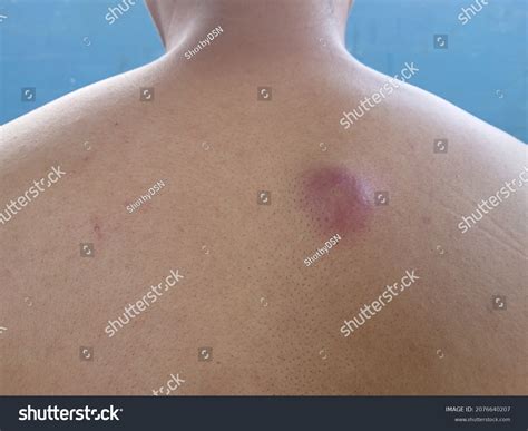 Lump On Back