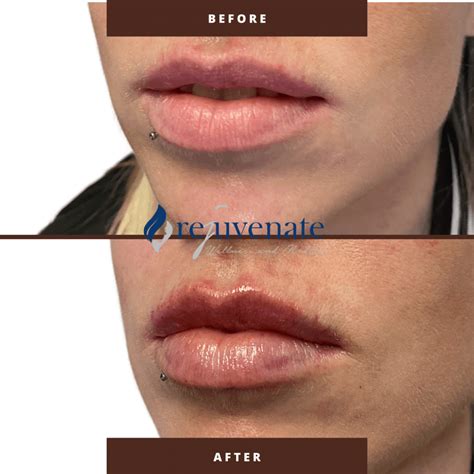 Lip Filler Before & After - Rejuvenate Wellness & Med Spa