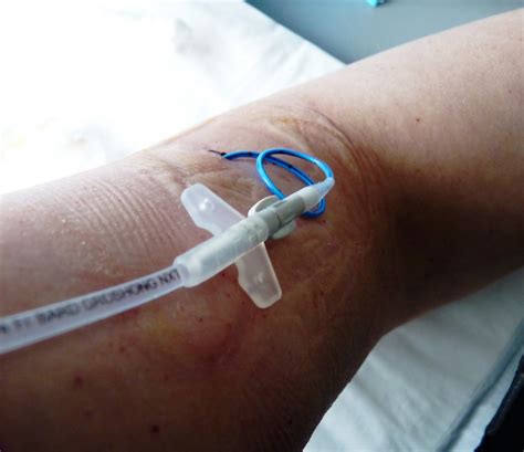 Dressing Change Picc Line at Wilfred King blog