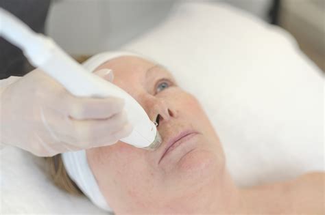 Radio Frequency Microneedling | Non-Surgical Facelift London