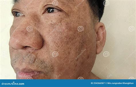 The Wrinkled Blemish and Dark Spots, Freckles and Acne on the Face ...