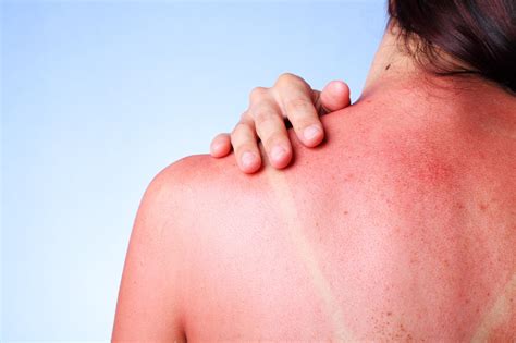 Sun Poisoning Sun Rash