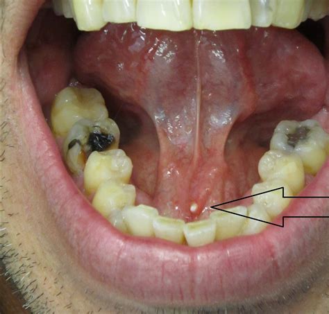 Submandibular Salivary Gland _ Sialadenitis (Salivary Gland Infection ...