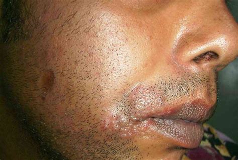 Pictures of Skin Infections: Causes and Treatments
