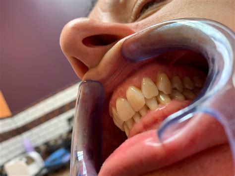 Teeth Whitening in New Lenox, IL | Lincolnway Dental Associates