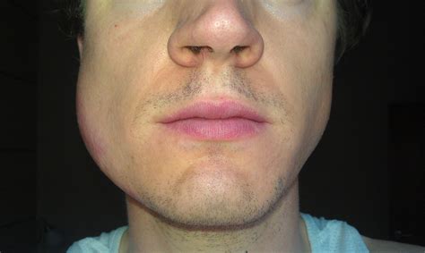 Lump On Jaw After Dental Injection at Jamie Gibb blog