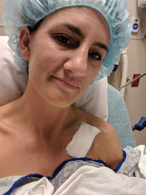 Port-a-Cath Insertion Surgery | a.steed's.life