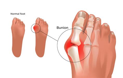 What Are Bunions