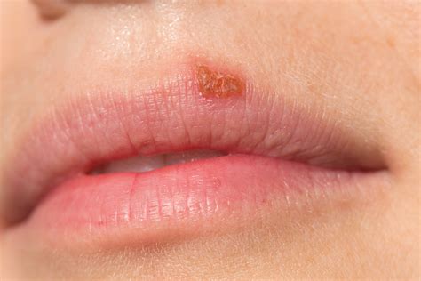 Early Stages Of Herpes On Lips | Lipstutorial.org