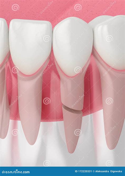 3d Render of Jaw with Cracked Tooth Root Stock Illustration - Illustration of broken, medical ...
