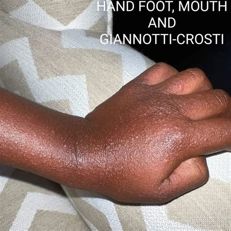 Gianotti Crosti Syndrome In Children