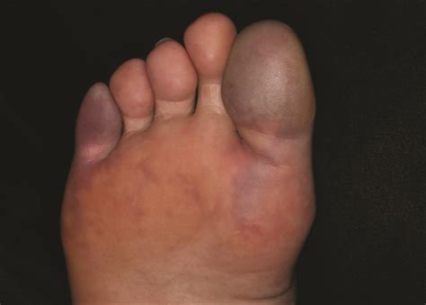 Purple Toes Symptom