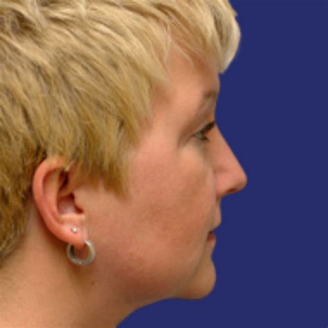 Chin liposuction photos before and after - Wellness Kliniek