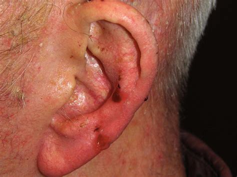 Skin Cancer On Ear