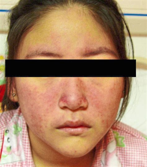 Children can also get systemic lupus erythematosus (SLE) | The Star