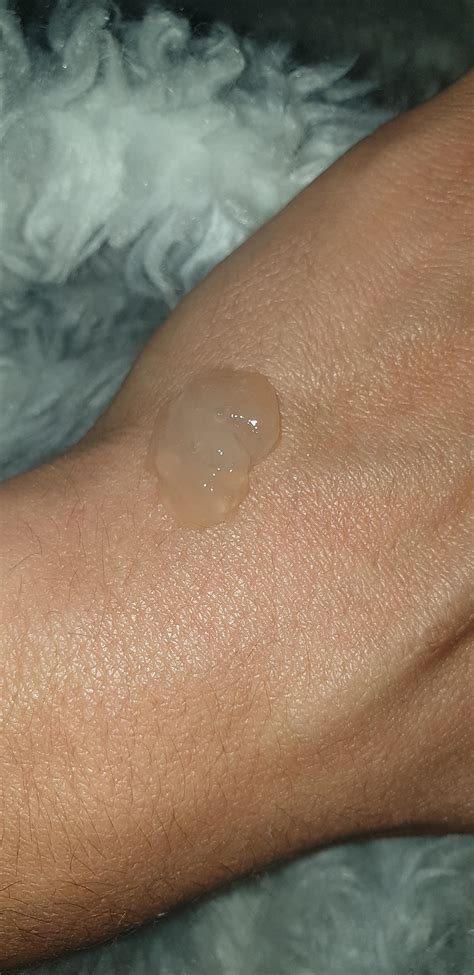 Weird jelly mucus, anybody else get it? You will know exactly what I'm ...