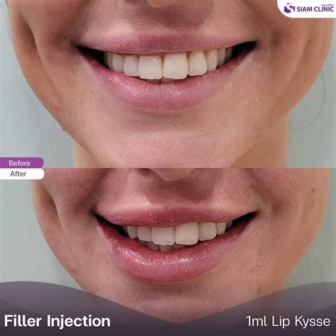 Lip Fillers Before and After Photos - Siam Clinic Thailand