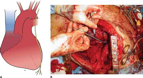 Emergency Department Thoracotomy - Trauma, 7th Ed.