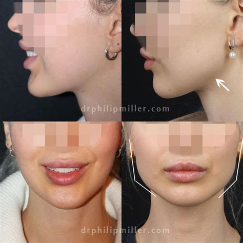 Jawline Surgery Women Women 'shunning Facial Plastic Surgery For