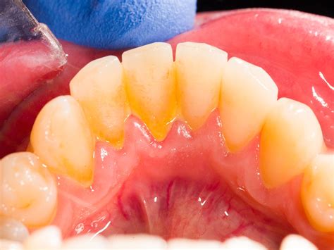 Dental Plaque On Teeth