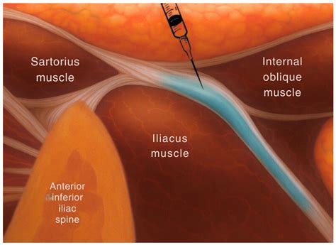 Supra Inguinal Fascia Iliac Versus PENG Block for Post-Operative Pain ...
