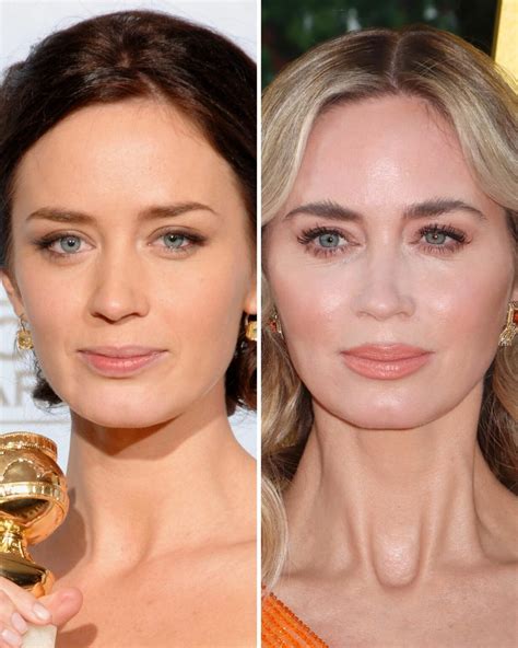 Emily Blunt Surgery Face