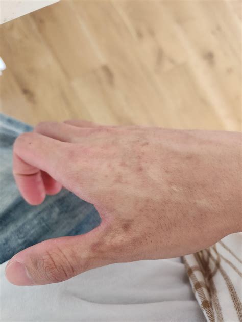 Brown spots formed all over my hands overnight.. never went away. : r/DermatologyQuestions