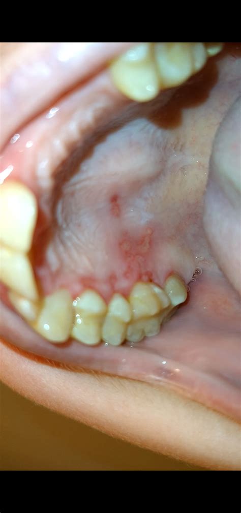 Cut On Roof Of Mouth Near Teeth at Daria Willis blog