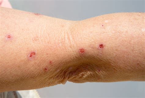 Skin Rash From Sun Treatment at William Fusco blog