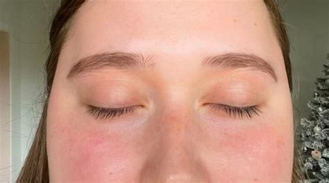 Eczema Face Causes Eczema Of The Face And Neck | Eau Thermale Avène
