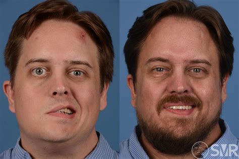 Cross Facial Nerve Graft for Eyelid Restoration Before and After Photo Gallery | Dallas, TX ...