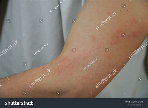 Itchy Rash On Elbow Joint at Troy Hager blog
