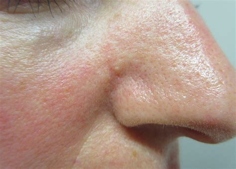 BCC on The Nose – Basal Cell Carcinoma Picture | Mr Tehrani – Mohs Surgeon