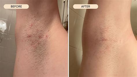 How to Remove Ingrown Armpit Hair: Proven Guide | Hair Away By Laser