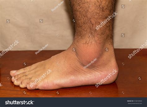 Gout Ankle
