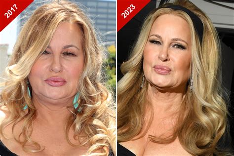 Celebrity Lower Blepharoplasty Before And After 60 Photos - Moonagedaydream.film