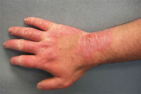 Contact Dermatitis: When Symptoms Start and Could End