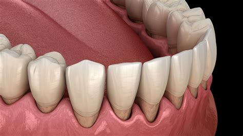 Causes of Gum Recession in Pensacola, FL | Dr. David Williams