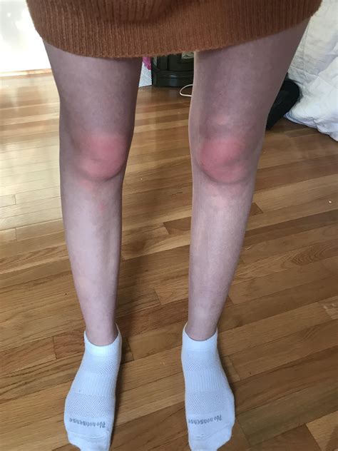 My Legs Are Swollen And Hot at Tyson Macgillivray blog