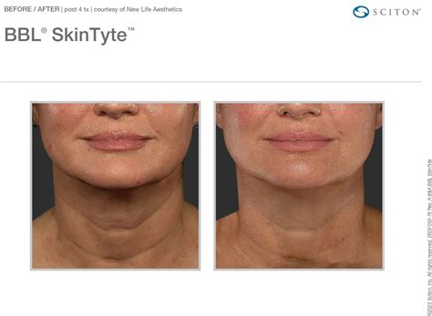 Neck & Chest Rejuvenation with BBL Laser | Dallas Derm Partners