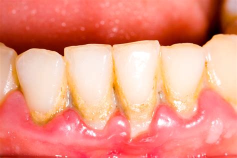 Gingivitis Contagious Worcester | Gum Disease | University Dental Group