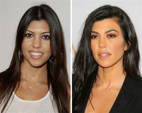 Kourtney Kardashian Face Surgery