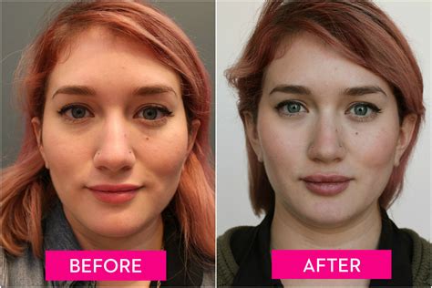 Bad Lip Injections Before And After