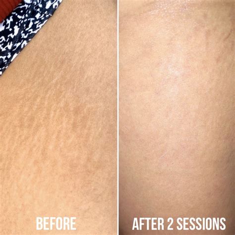 Tattoo Cover Stretch Marks, Stretch Marks On Legs, Stretch Mark Cream, Cover Up Tattoos, Stretch ...