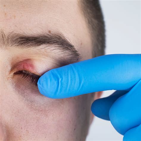 All About Blepharitis: Itchy, Inflamed Eyelids - HubPages