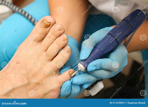Doctor Treats an Ingrown Toenail with a Medical Instrument, Removal and Disinfection Stock Image ...