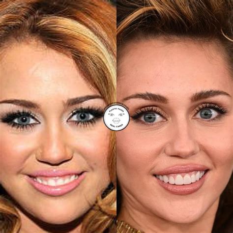 Miley Cyrus Plastic Surgery
