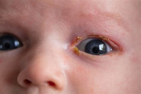 Meaning Of Yellow Eyes In Babies at Imogen Parry-okeden blog